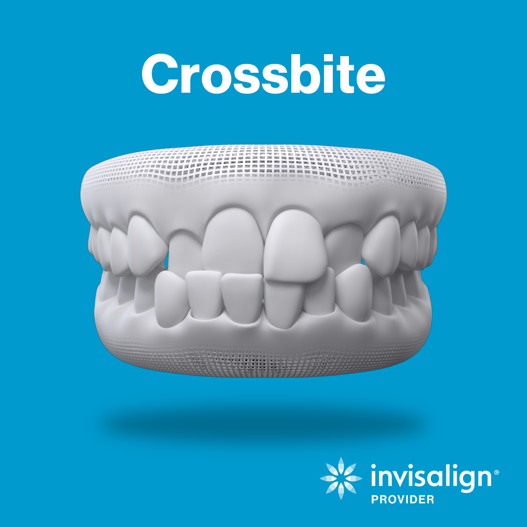 Crossbite_7_11_2022_1_33_05_PM