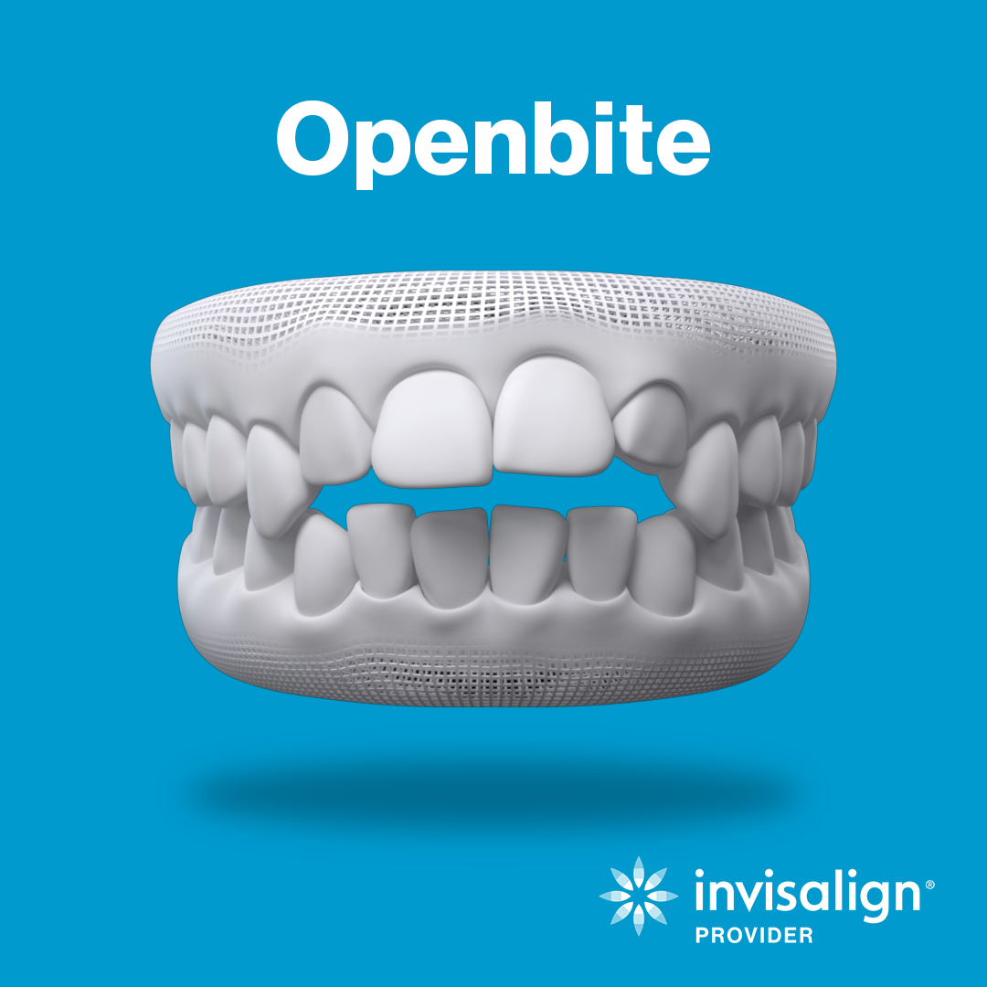 Openbite_7_11_2022_1_32_47_PM