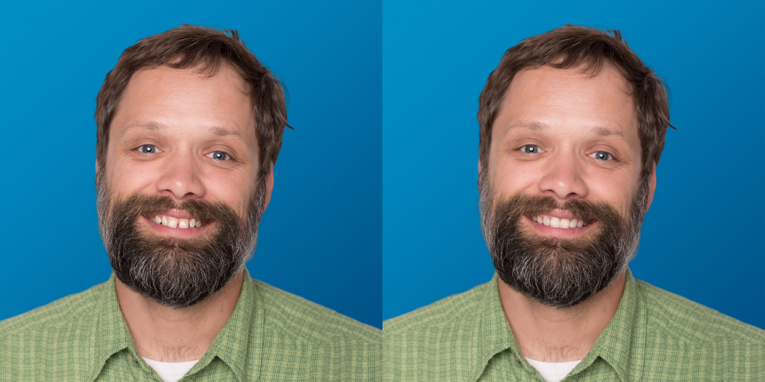 SmileView-BeforeAfter09Dan